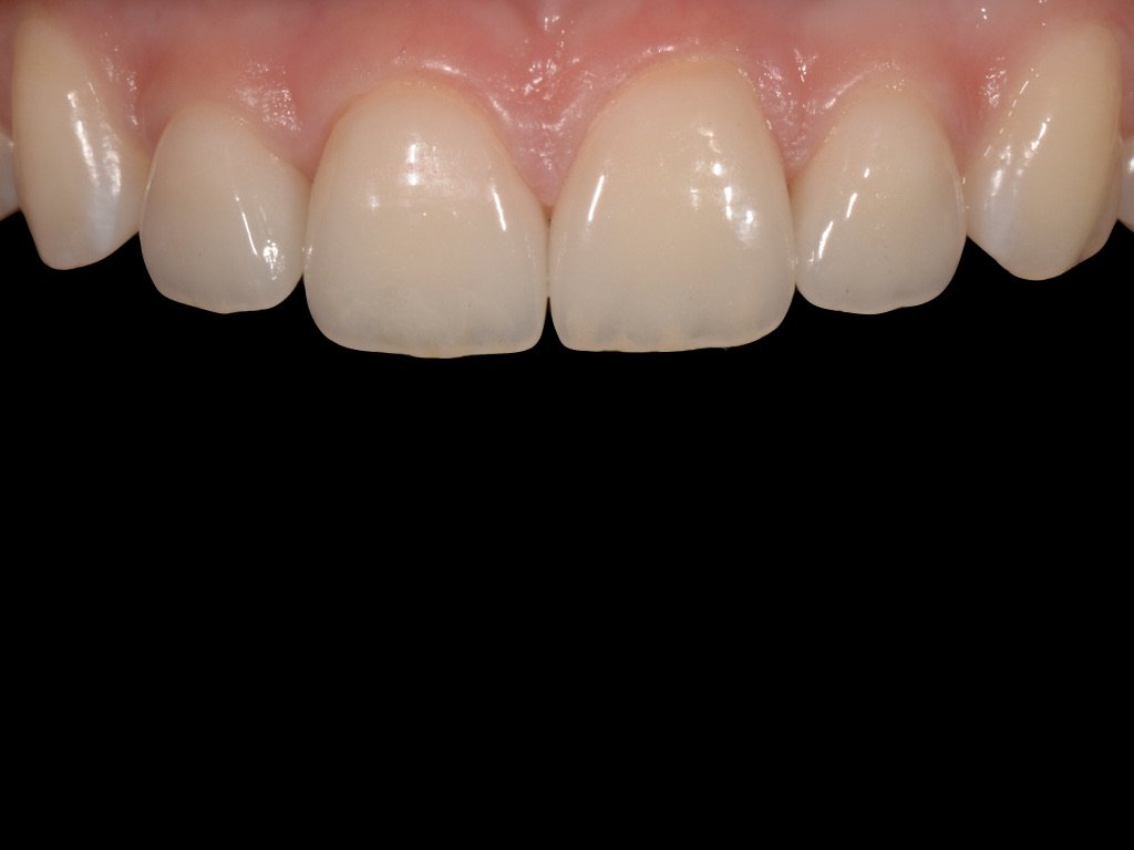 After treatment: the gap closed and the incisal edges restored to an even line.