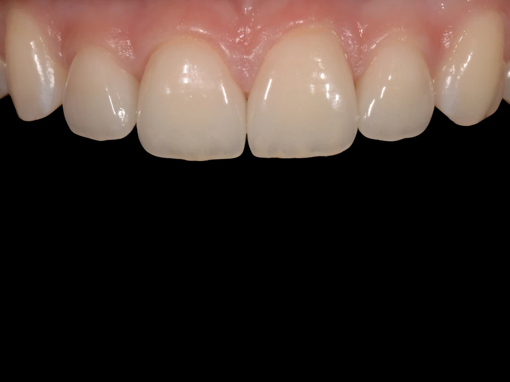 After treatment: the gap closed and the incisal edges restored to an even line.