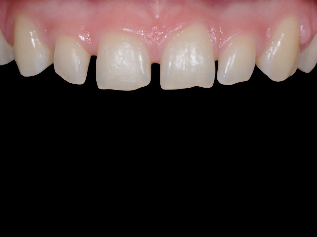Before treatment: uneven incisal edges and a gap between the upper central incisors.