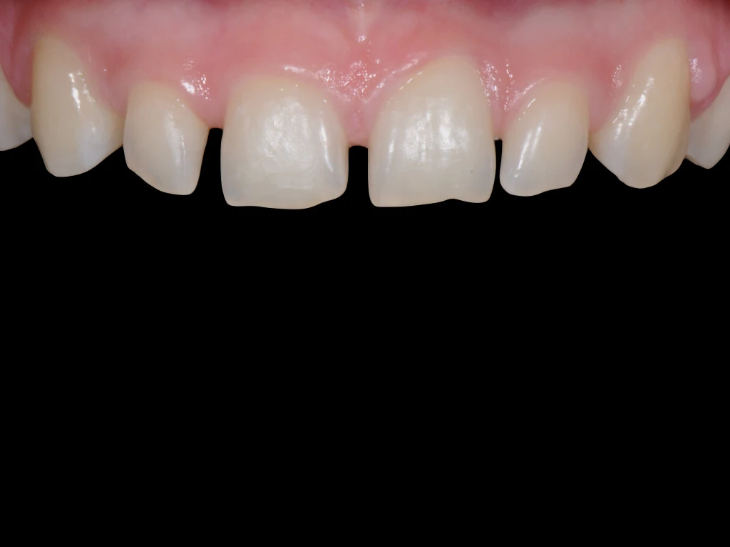 Before treatment: uneven incisal edges and a gap between the upper central incisors.
