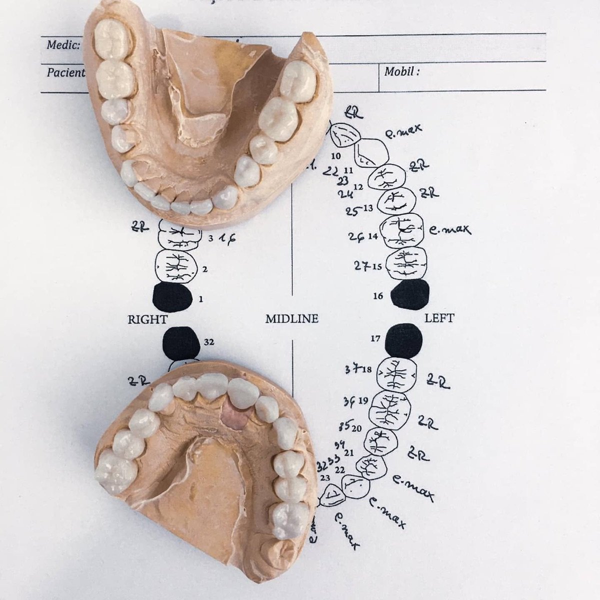 A written treatment plan: study models beside a tooth chart, with the material noted against each planned unit.